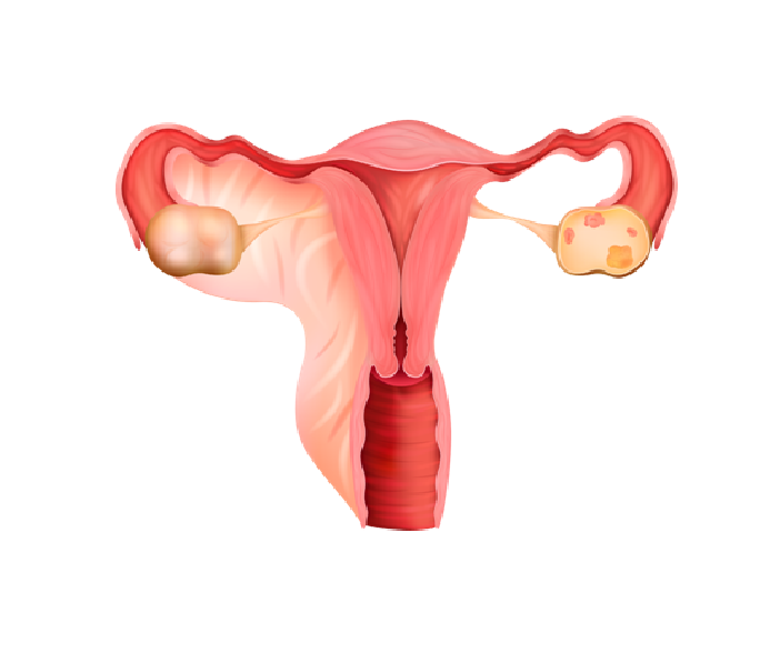 PCOS: The Hidden Puzzle Affecting Millions of Women