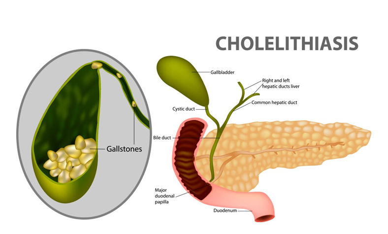 Understanding Cholelithiasis: Causes, Symptoms, and Treatment – A Guide by ITM Hospital