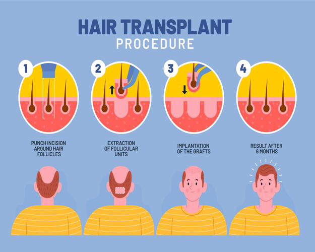 Hair Transplant Surgery: A Simple Guide to Restoring Your Hair