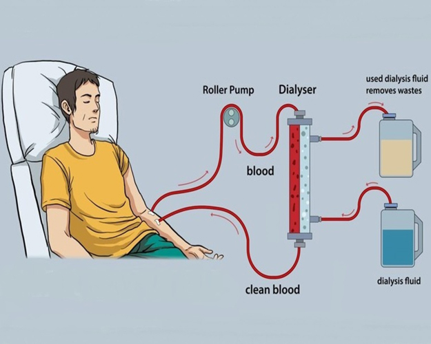 Living with Dialysis: Tips for Kidney Disease Patients