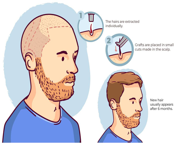 Benefits of Hair Transplant: A Permanent Solution to Hair Loss