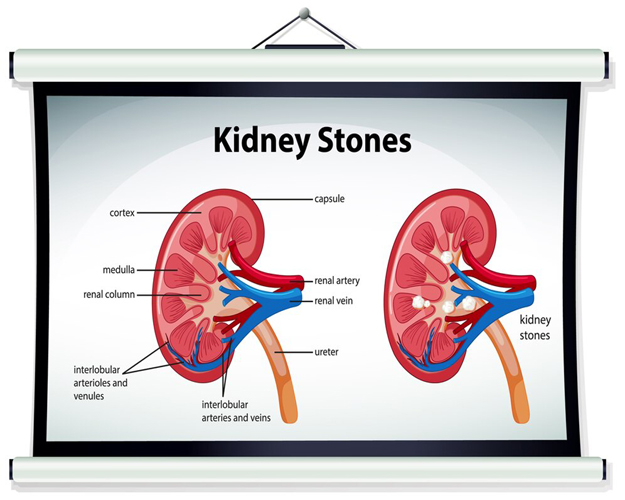 Demystifying Kidney Stone Treatment: A Guide to Shock Wave Lithotripsy