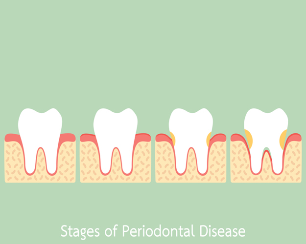 Gum Health Matters: Preventing and Treating Periodontal Disease