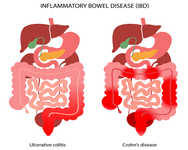 Understanding Chronic Obstructive Pulmonary Disease (COPD): A Guide by ITM Hospital