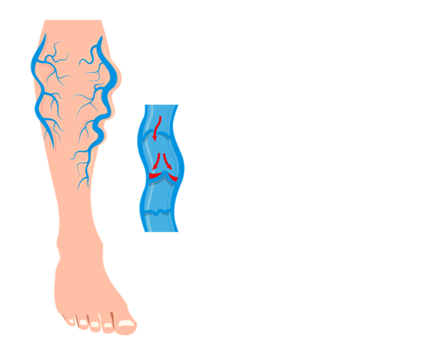 Understanding Varicose Veins: Causes, Symptoms, and Modern Treatments