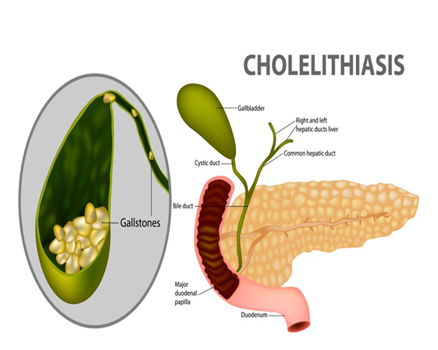 Understanding Cholelithiasis: Causes, Symptoms, and Treatment â€“ A Guide by ITM Hospital