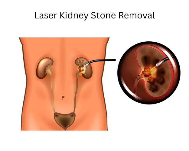 Laser Kidney Stone Removal Gwalior: Safe, Modern, Effective Treatment at ITM Hospital